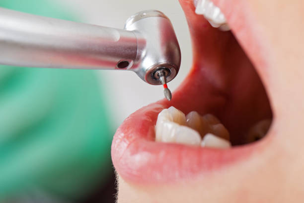Best Emergency Tooth Extraction in New Britain, CT